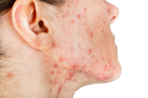 cystic acne on skin 
